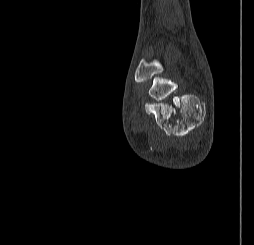 Calcaneal fracture - Sanders type 4 (Radiopaedia 90179-107370 Coronal bone window 76).jpg