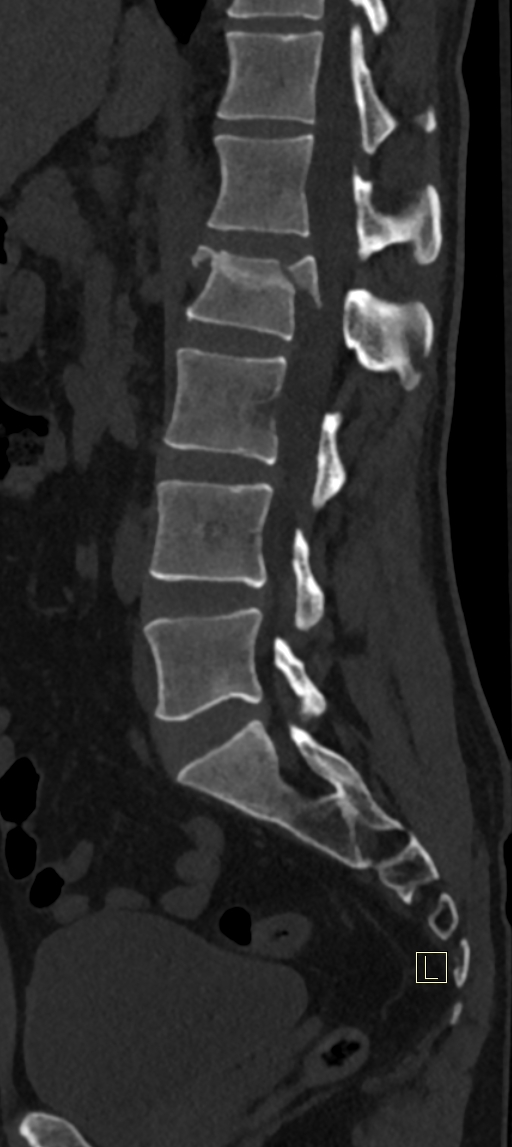 Calcaneal fractures with associated L2 burst fracture (Radiopaedia 71671-82493 Sagittal bone window 36).jpg