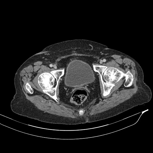 Calcified adrenal glands and Spigelian hernia (Radiopaedia 49741-54988 A 233).jpg