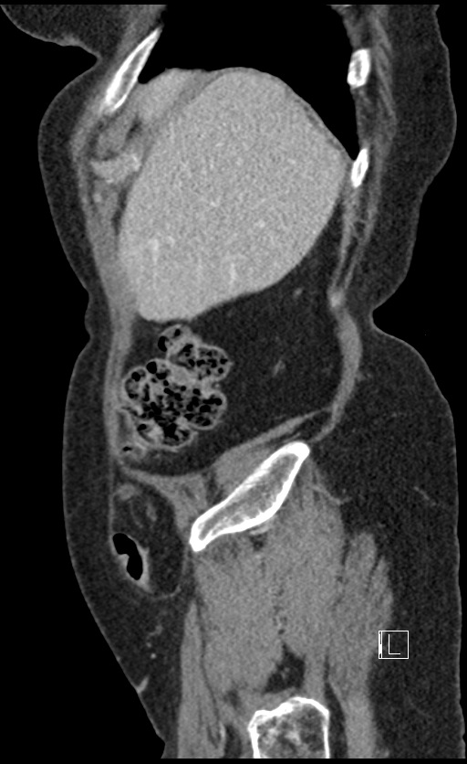 Calcified adrenal glands and Spigelian hernia (Radiopaedia 49741-54988 C 140).jpg