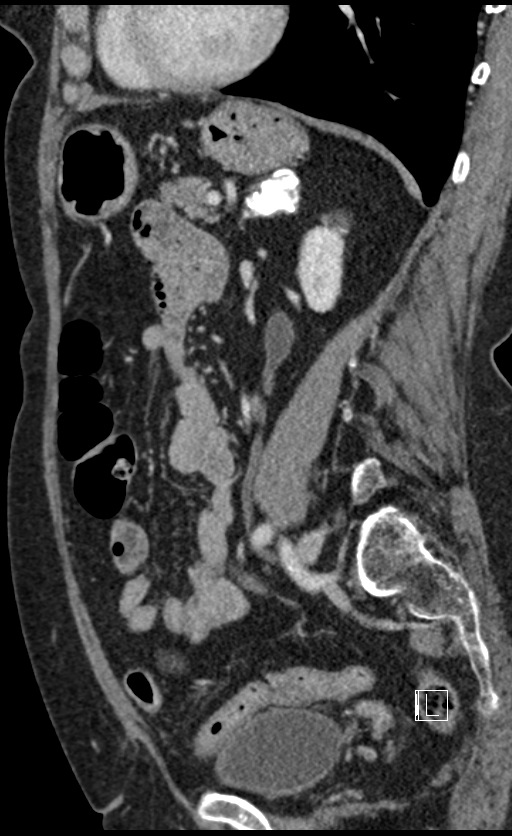 Calcified adrenal glands and Spigelian hernia (Radiopaedia 49741-54988 C 60).jpg