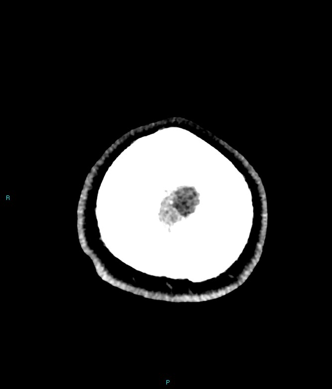 Calcified cerebral emboli from left ventricular thrombus (Radiopaedia 84420-99758 Axial non-contrast 6).jpg