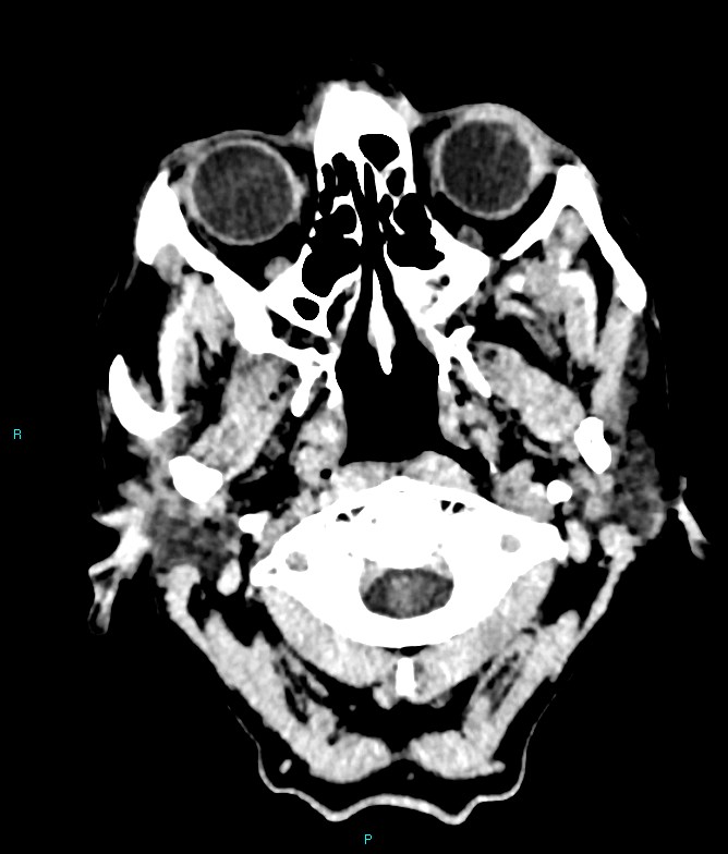 Calcified cerebral emboli from left ventricular thrombus (Radiopaedia 84420-99758 Axial non-contrast 88).jpg