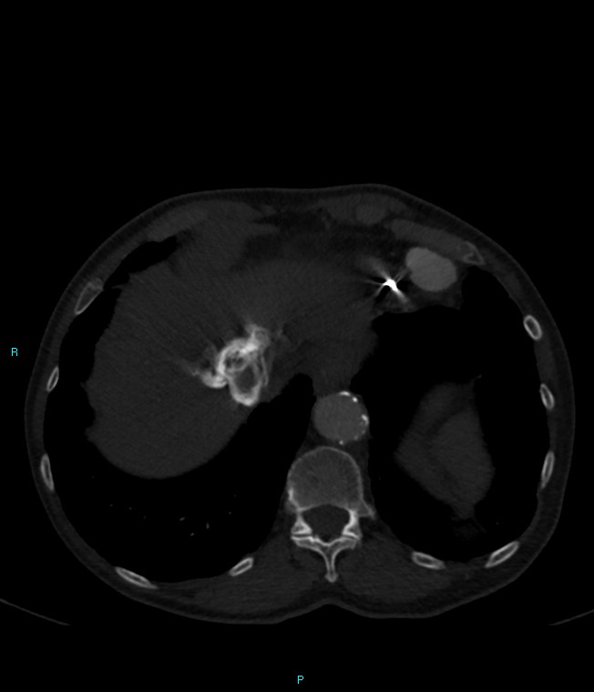 Calcified cerebral emboli from left ventricular thrombus (Radiopaedia 84420-99760 Axial bone window 72).jpg