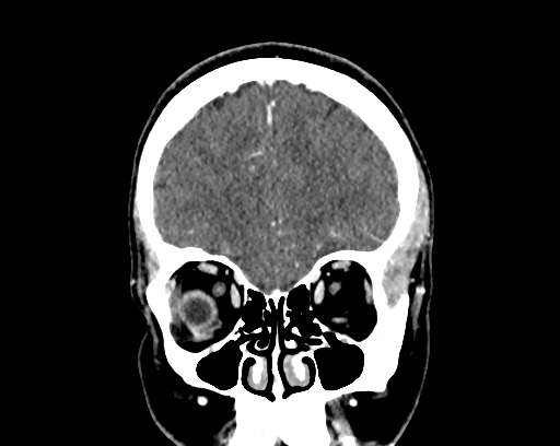 File:Calcified cerebral hydatid cyst (Radiopaedia 65603-74717 C 13).jpg