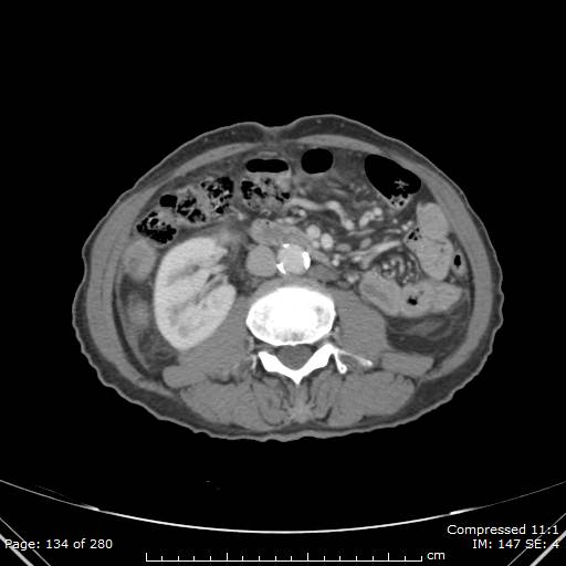 Calcified liver metastases (Radiopaedia 44699-48470 B 48).jpg
