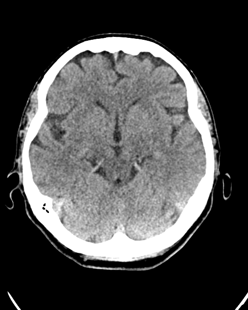 Calcified meningioma (Radiopaedia 74361-85243 Axial non-contrast 32).jpg