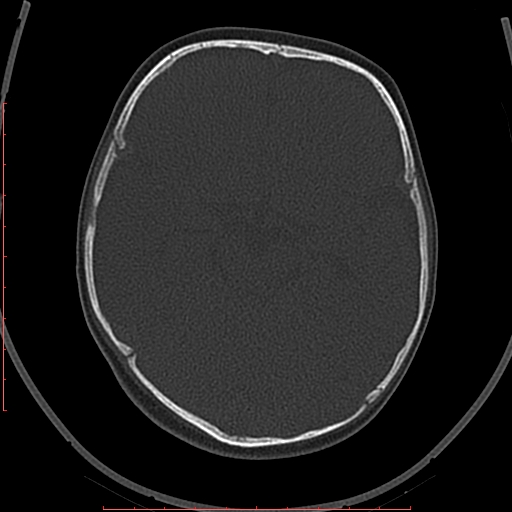File:Calcified middle cerebral artery embolism (Radiopaedia 78949-91860 Axial bone window 21).jpg