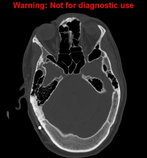 Calvarial thickening from chronic shunting (Radiopaedia 60079-67637 Axial bone window 57).jpg