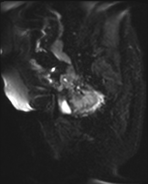 Cancer cervix - stage IIb (Radiopaedia 75411-86615 Sagittal DWI 6).jpg