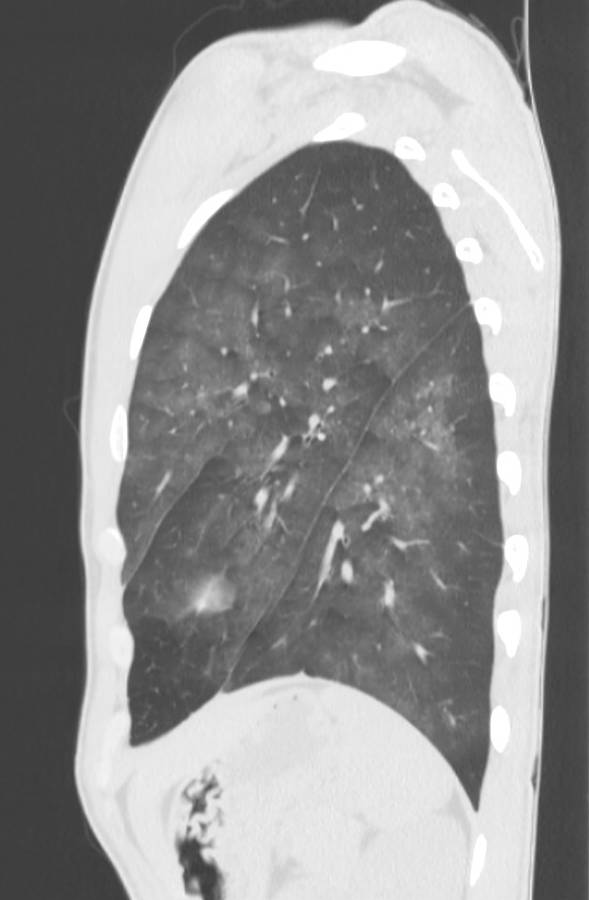 Cannabis-induced diffuse alveolar hemorrhage (Radiopaedia 89834-106946 Sagittal lung window 110).jpg