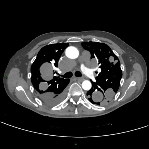 Cannonball metastases (Radiopaedia 82110-96150 Axial C+ CTPA 135).jpg