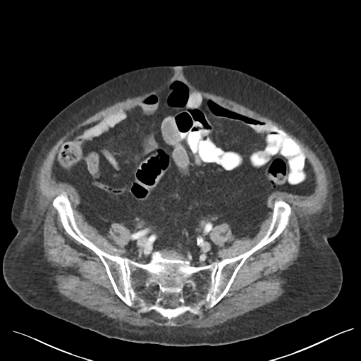 Cannonball metastases from endometrial cancer (Radiopaedia 42003-45031 E 57).png