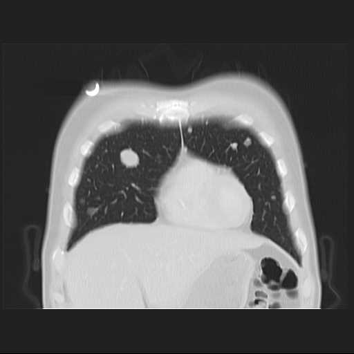 File:Cannonball pulmonary metastases (Radiopaedia 67684-77101 C 4).jpg