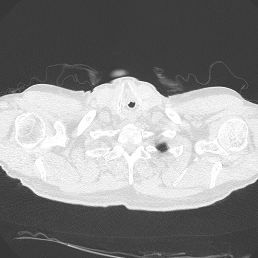 Caplan syndrome (Radiopaedia 56667-63530 Axial lung window 13).jpg