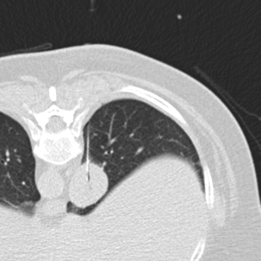 File:Carcinoid tumor - lung (Radiopaedia 44814-48644 Axial lung window 83).png