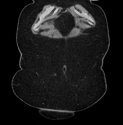 Carcinoid tumor - terminal ileum (Radiopaedia 60931-68740 Coronal non-contrast 4).jpg