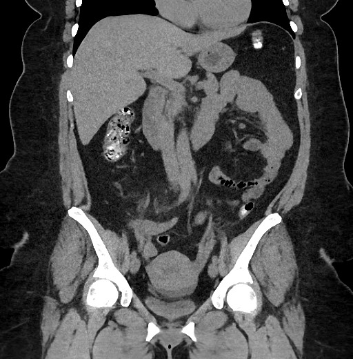 Carcinoid tumor - terminal ileum (Radiopaedia 60931-68740 Coronal non-contrast 47).jpg