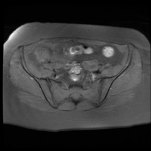 File:Carcinoma of the cervix (Radiopaedia 89018-105858 Axial T1 fat sat 3).jpg