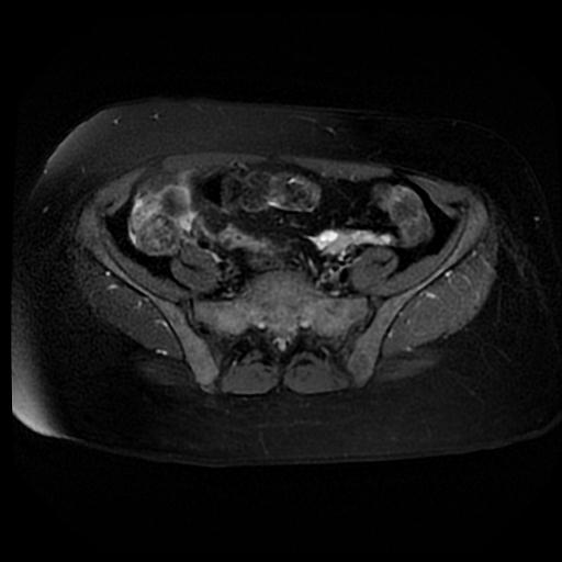 File:Carcinoma of the cervix (Radiopaedia 89018-105858 Axial T2 fat sat 1).jpg