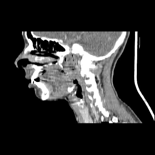 Carcinoma of the maxillary antrum (Radiopaedia 53805-59888 Sagittal C+ delayed 112).jpg