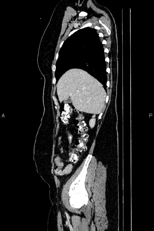 Carcinoma of uterine cervix (Radiopaedia 85861-101700 D 13).jpg