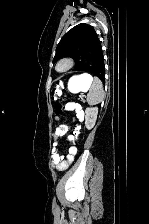 Carcinoma of uterine cervix (Radiopaedia 85861-101700 D 68).jpg