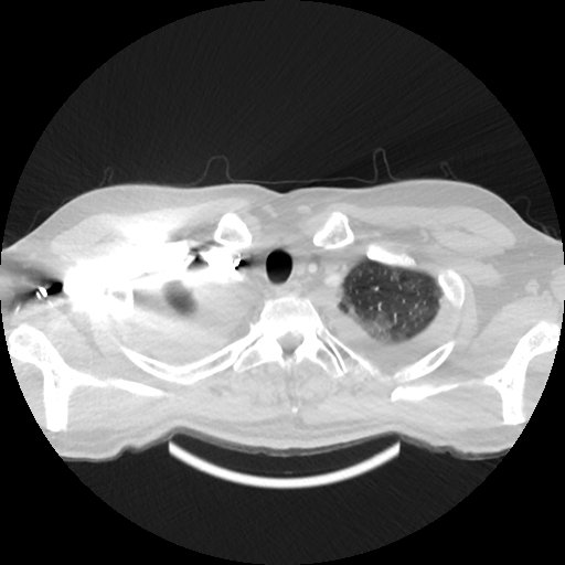 Cardiac tamponade (Radiopaedia 78607-91368 Axial lung window 3).jpg