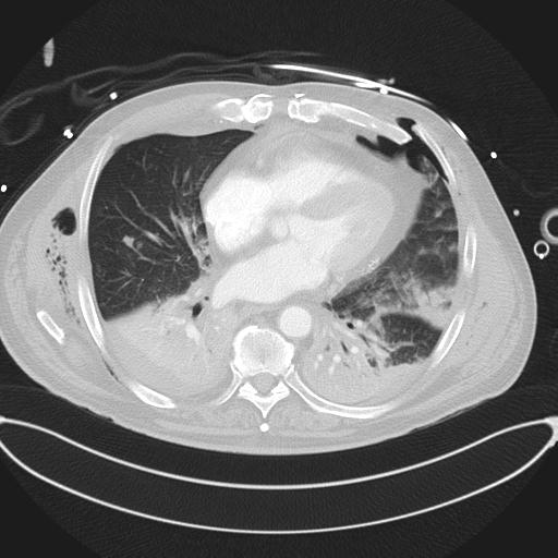 Cardiac trauma (Radiopaedia 32874-33858 Axial lung window 34).jpg