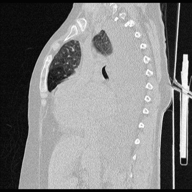 Cardiogenic pulmonary edema (Radiopaedia 29213-29609 Sagittal lung window 42).jpg