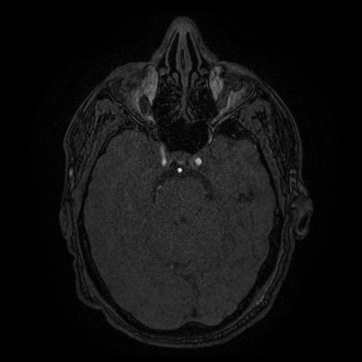 File:Carotid arterial dissection with acute cerebral infarction (Radiopaedia 26636-26784 MRA 114).jpg