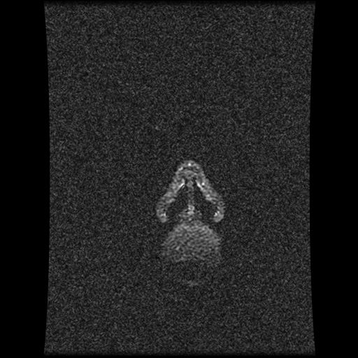 Carotid arterial dissection with acute cerebral infarction (Radiopaedia 26636-26784 MRV 166).jpg