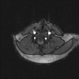 Carotid artery dissection (Radiopaedia 28441-28689 Axial MRA 26).jpg