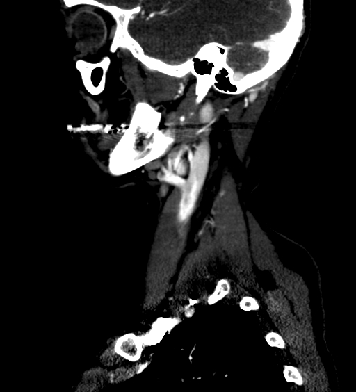 File:Carotid body tumor (Radiopaedia 39845-42300 D 2).jpg