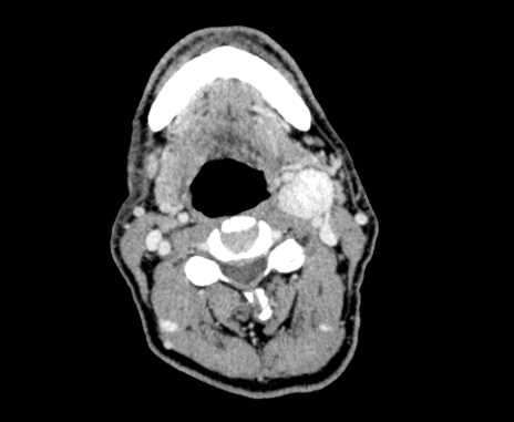 Carotid body tumor (Radiopaedia 61750-69757 Axial Post contrast 46).jpg
