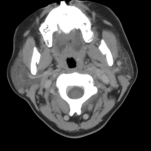 Carotid body tumor (paraganglioma) (Radiopaedia 38586-40729 A 47).jpg