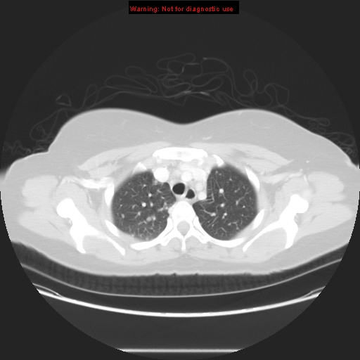 File:Carotid body tumor with lung metastases (Radiopaedia 9301-48390 Axial lung window 20).jpg