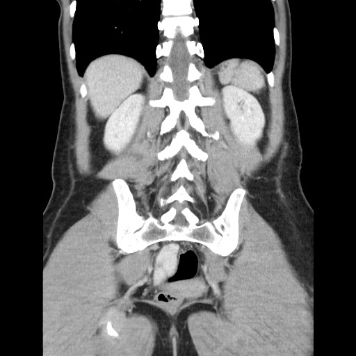 Castleman disease with fibrous pseudotumor in the abdomen (Radiopaedia 77296-89373 B 72).jpg