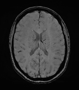 File:Cavernoma with bleed - midbrain (Radiopaedia 54546-60773 Axial SWI 29).png