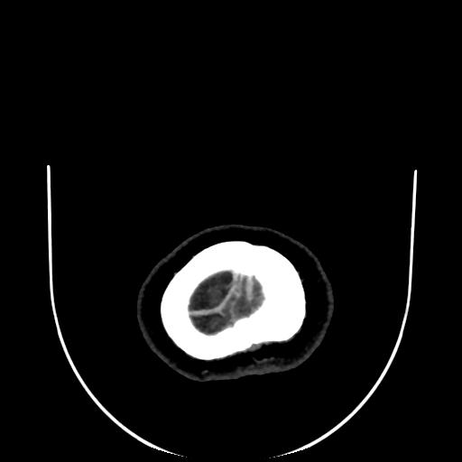 Cavernoma with developmental venous anomaly (Radiopaedia 22470-22506 C 201).jpg