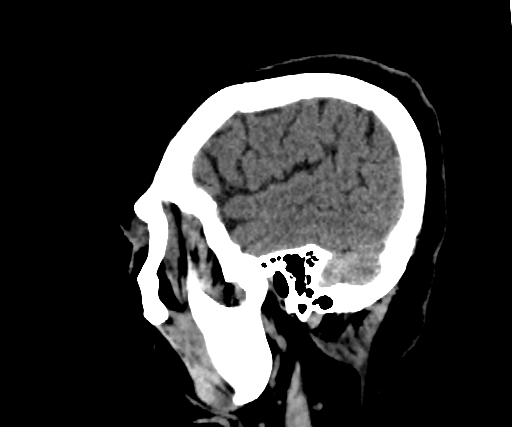 Cavernous hemangioma of the cerebellar falx (Radiopaedia 73025-83723 B 57).jpg