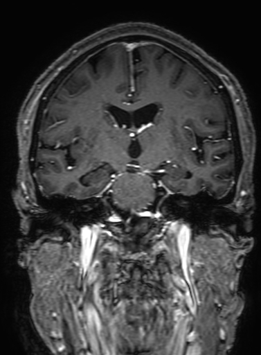 Cavernous hemangioma of the cerebellar falx (Radiopaedia 73025-83724 Coronal T1 C+ 192).jpg