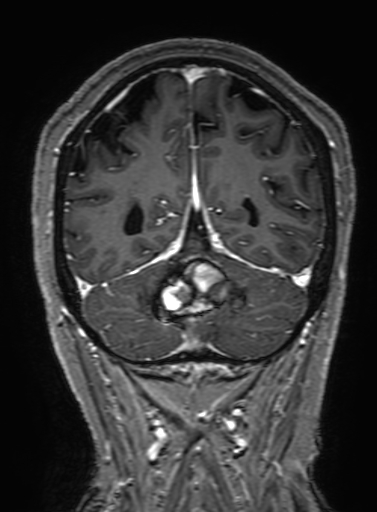 Cavernous hemangioma of the cerebellar falx (Radiopaedia 73025-83724 Coronal T1 C+ 287).jpg
