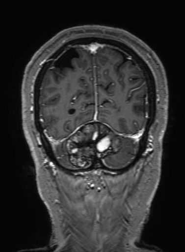 Cavernous hemangioma of the cerebellar falx (Radiopaedia 73025-83724 Coronal T1 C+ 319).jpg