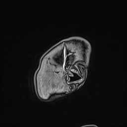 Cavernous sinus meningioma (Radiopaedia 63682-72367 Sagittal T1 C+ 17).jpg