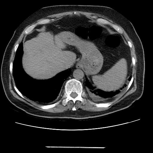 Cavitating pulmonary metastases (Radiopaedia 89545-106544 Axial non-contrast 48).jpg