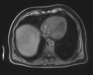 Cecal mass causing appendicitis (Radiopaedia 59207-66532 Axial T1 19).jpg