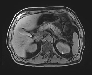 Cecal mass causing appendicitis (Radiopaedia 59207-66532 Axial T1 44).jpg