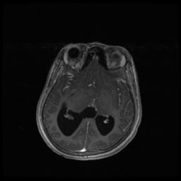 Central neurocytoma (Radiopaedia 30220-30842 Axial T1 C+ 73).jpg