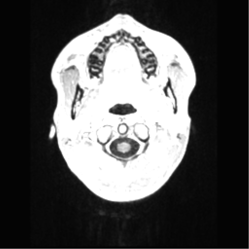 File:Central neurocytoma (Radiopaedia 37664-39557 Axial T1 C+ 2).png